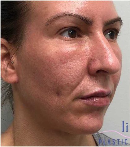 Chin Augmentation Before & After Patient #1747