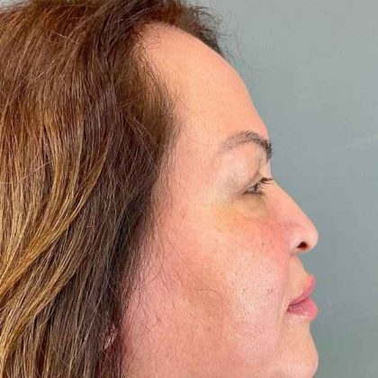 Eyelid Surgery Before & After Patient #1754