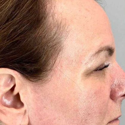 Eyelid Surgery Before & After Patient #1768
