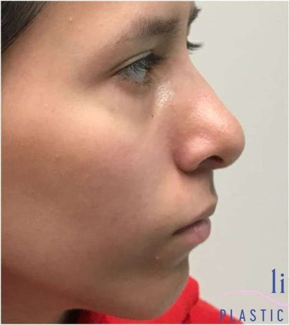 Rhinoplasty Before & After Patient #1796