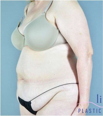 Tummy Tuck Before & After Patient #325