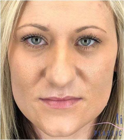 Rhinoplasty Before & After Patient #1807