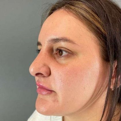 Rhinoplasty Before & After Patient #1818