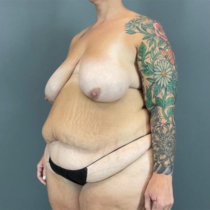 Breast Reduction Before & After Patient #1826