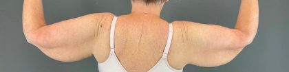 Arm Lift Before & After Patient #219