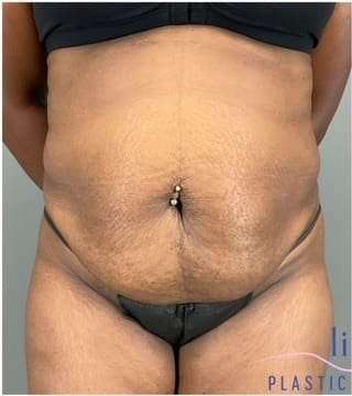 Tummy Tuck Before & After Patient #339