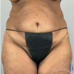 Tummy Tuck Before & After Patient #346