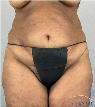 Tummy Tuck Before & After Patient #346