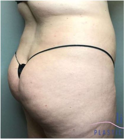Liposuction Before & After Patient #166