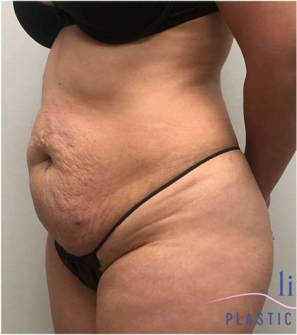Tummy Tuck Before & After Patient #357