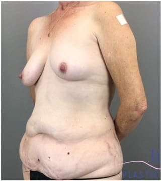 Tummy Tuck Before & After Patient #368