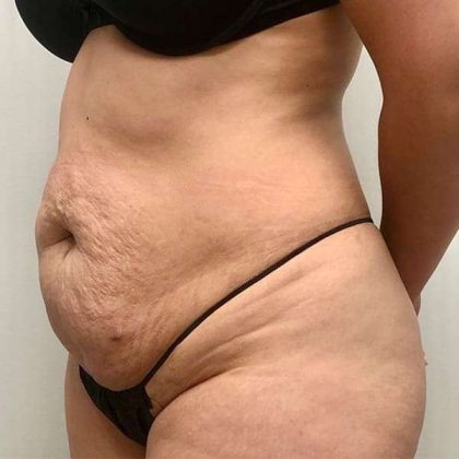 Tummy Tuck Before & After Patient #379