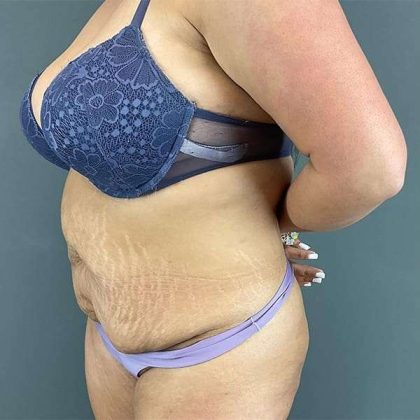 Tummy Tuck Before & After Patient #390