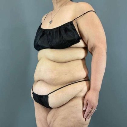 Tummy Tuck Before & After Patient #401