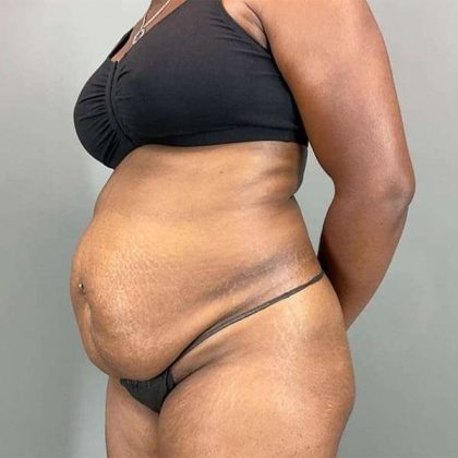 Tummy Tuck Before & After Patient #423