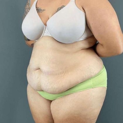 Tummy Tuck Before & After Patient #434