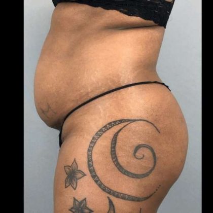 Tummy Tuck Before & After Patient #454