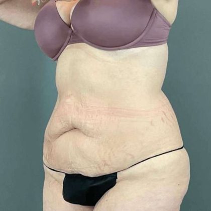 Tummy Tuck Before & After Patient #476