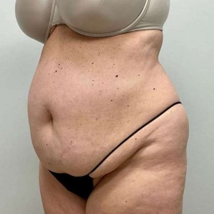 Tummy Tuck Before & After Patient #498