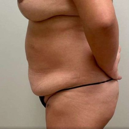 Tummy Tuck Before & After Patient #509