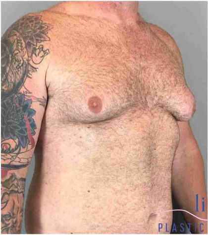 Gynecomastia Before & After Patient #560