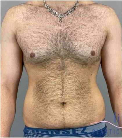 Liposuction Before & After Patient #188