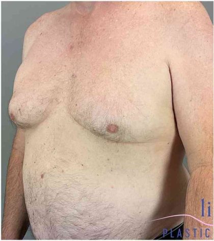 Gynecomastia Before & After Patient #571