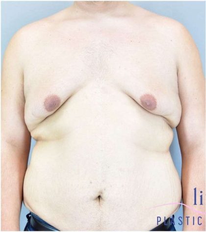 Gynecomastia Before & After Patient #582