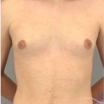 Gynecomastia Before & After Patient #593