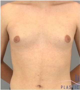 Gynecomastia Before & After Patient #593