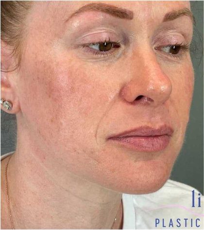 Injectables&Fillers Before & After Patient #118
