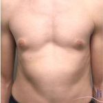 Gynecomastia Before & After Patient #604