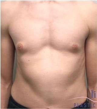 Gynecomastia Before & After Patient #604