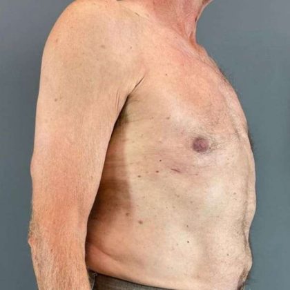 Gynecomastia Before & After Patient #611