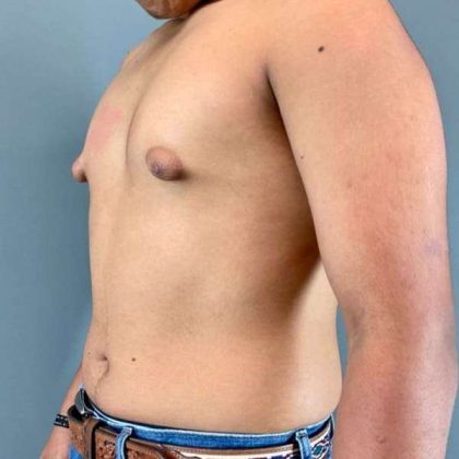 Gynecomastia Before & After Patient #622