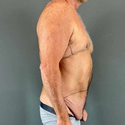 Gynecomastia Before & After Patient #629