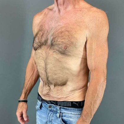 Gynecomastia Before & After Patient #642