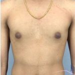 Gynecomastia Before & After Patient #653