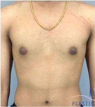 Gynecomastia Before & After Patient #653