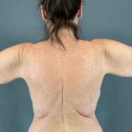 Arm Lift Before & After Patient #210
