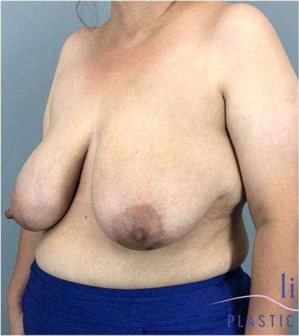 Breast Reduction Before & After Patient #675