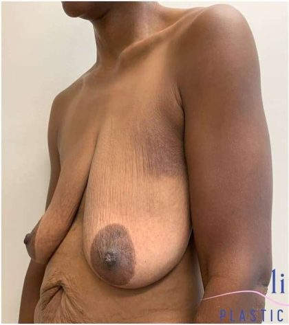 Breast Reduction Before & After Patient #686