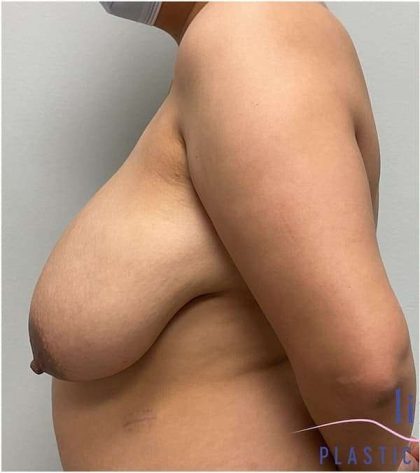 Breast Reduction Before & After Patient #697