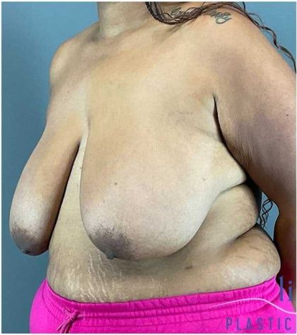 Breast Reduction Before & After Patient #708