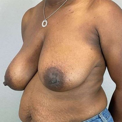 Breast Reduction Before & After Patient #730
