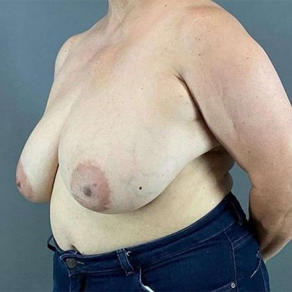 Breast Reduction Before & After Patient #763