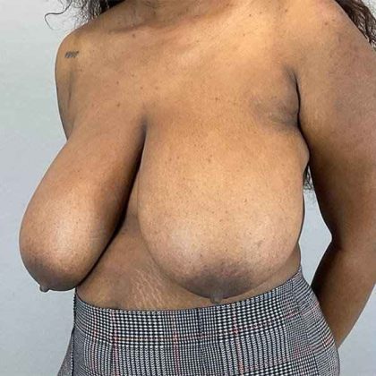 Breast Reduction Before & After Patient #774