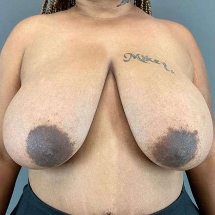 Breast Reduction Before & After Patient #792