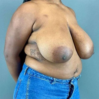 Breast Reduction Before & After Patient #810