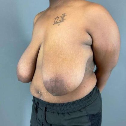 Breast Reduction Before & After Patient #828